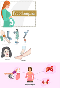 Illustration showing the symptoms and outcomes of preeclampsia.